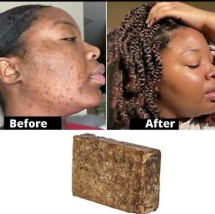 100G AFRICAN BLACK SOAP Shea Butter Bar Moisturizing Acne Treatment Cleanser for Clear Skin Care Deep Cleaning Glowing